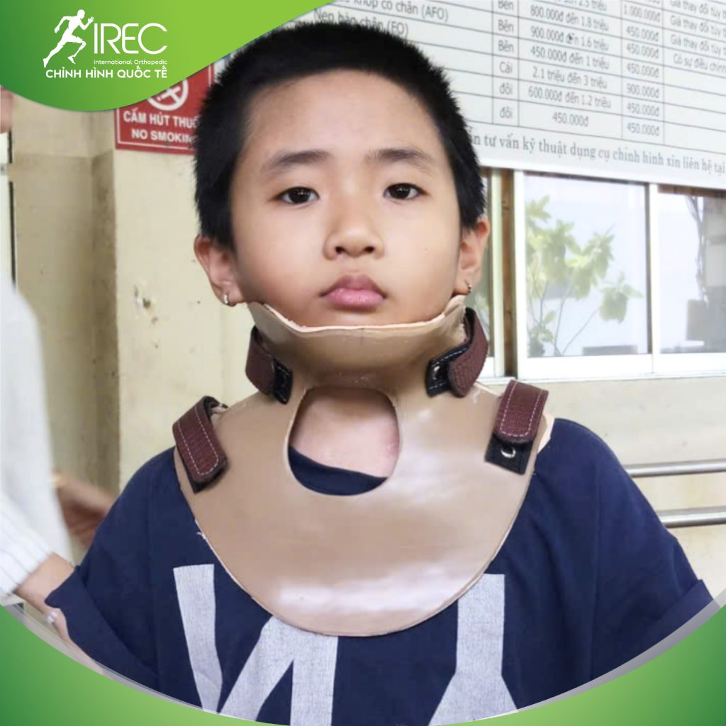 kích thước nẹp cổ