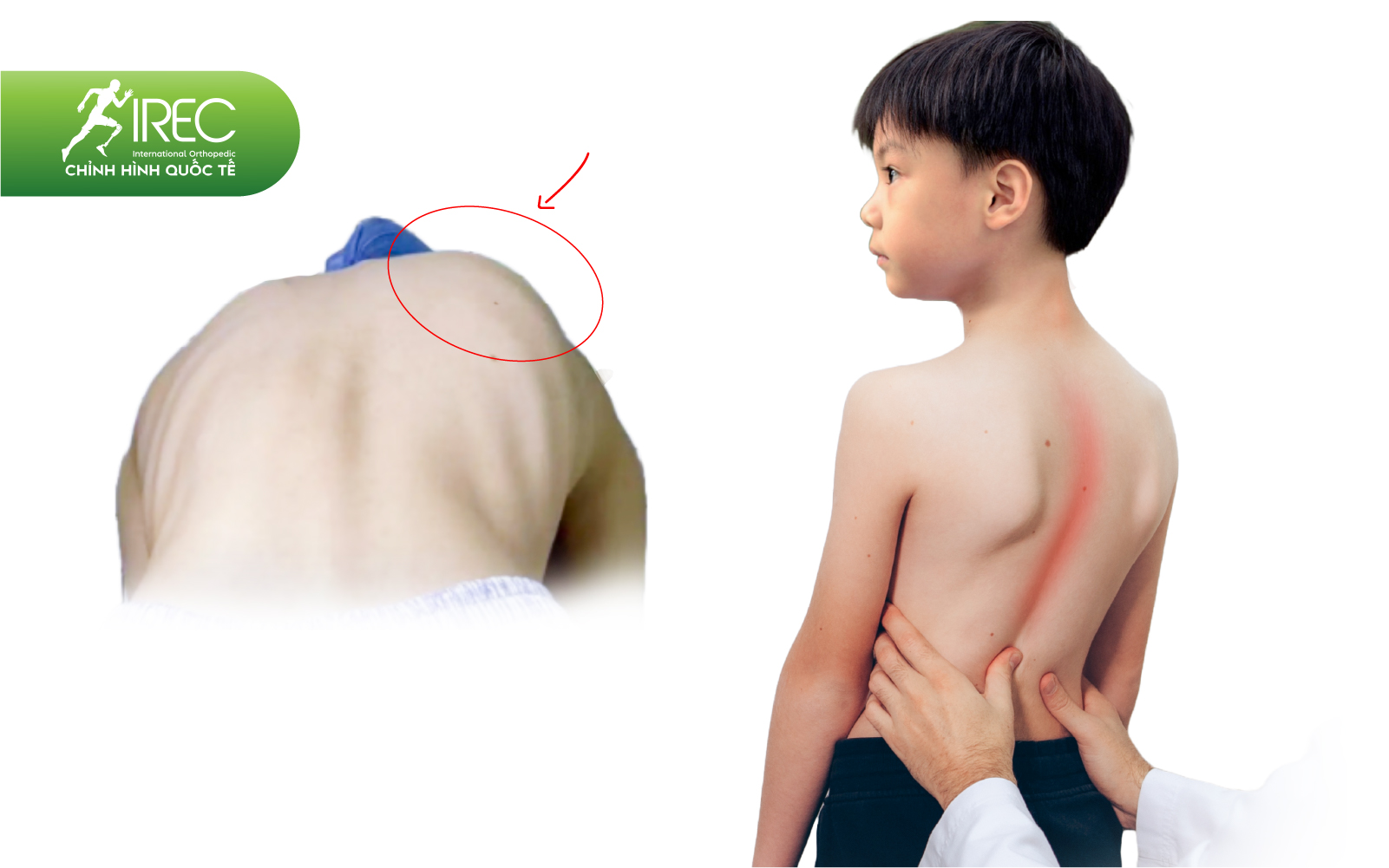 áo chỉnh hình 3D