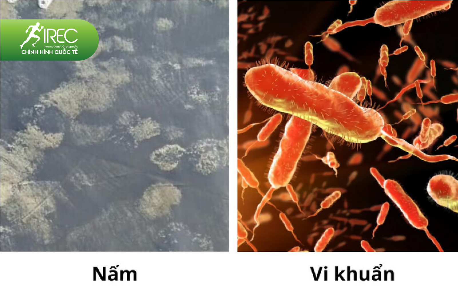 vệ sinh ngón chân giả