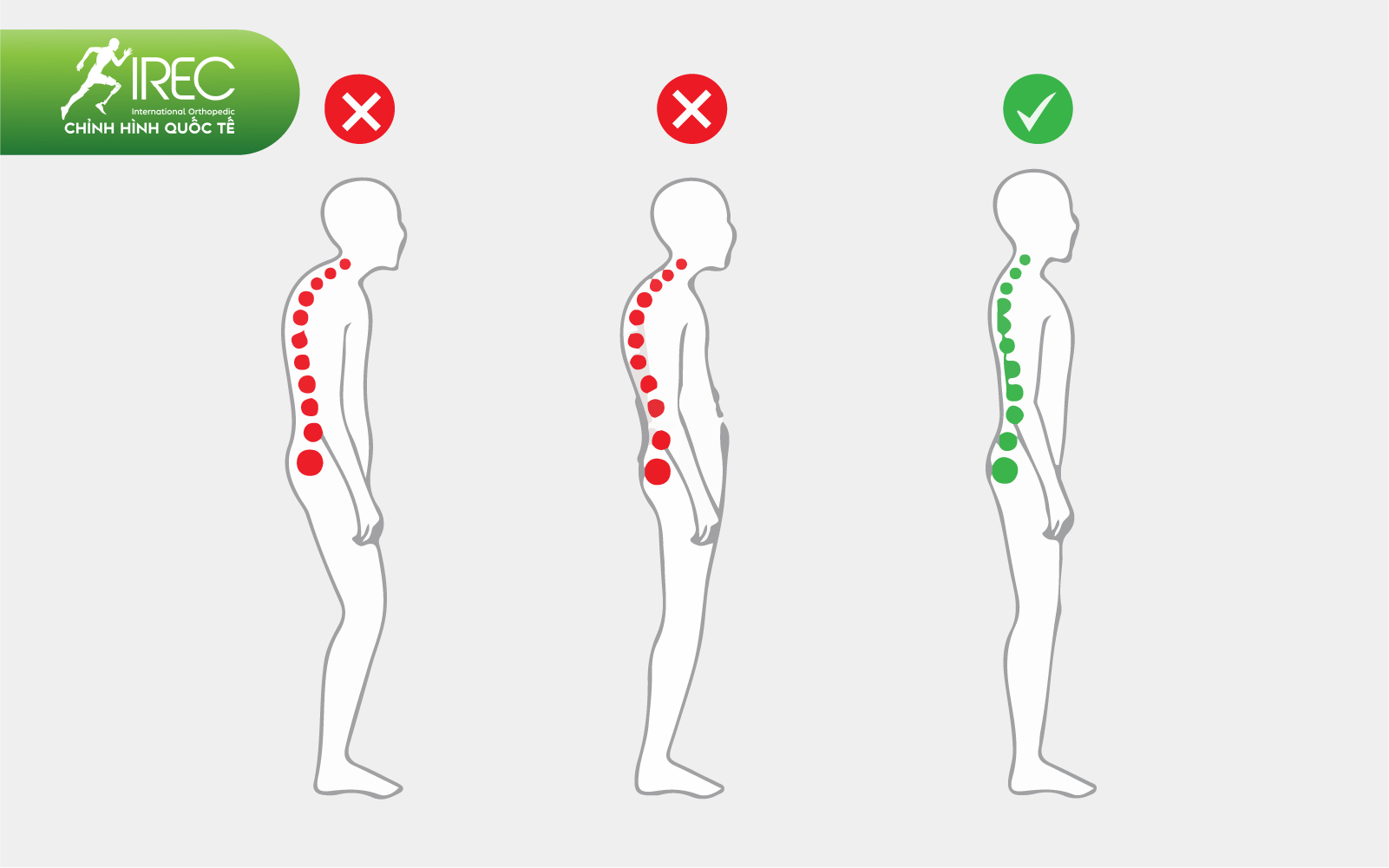 áo chỉnh hình cột sống 2D