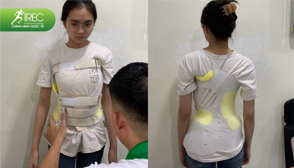 áo chỉnh hình cột sống 2D