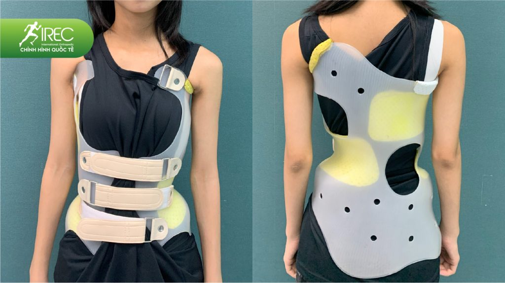 áo chỉnh hình cột sống 2D
