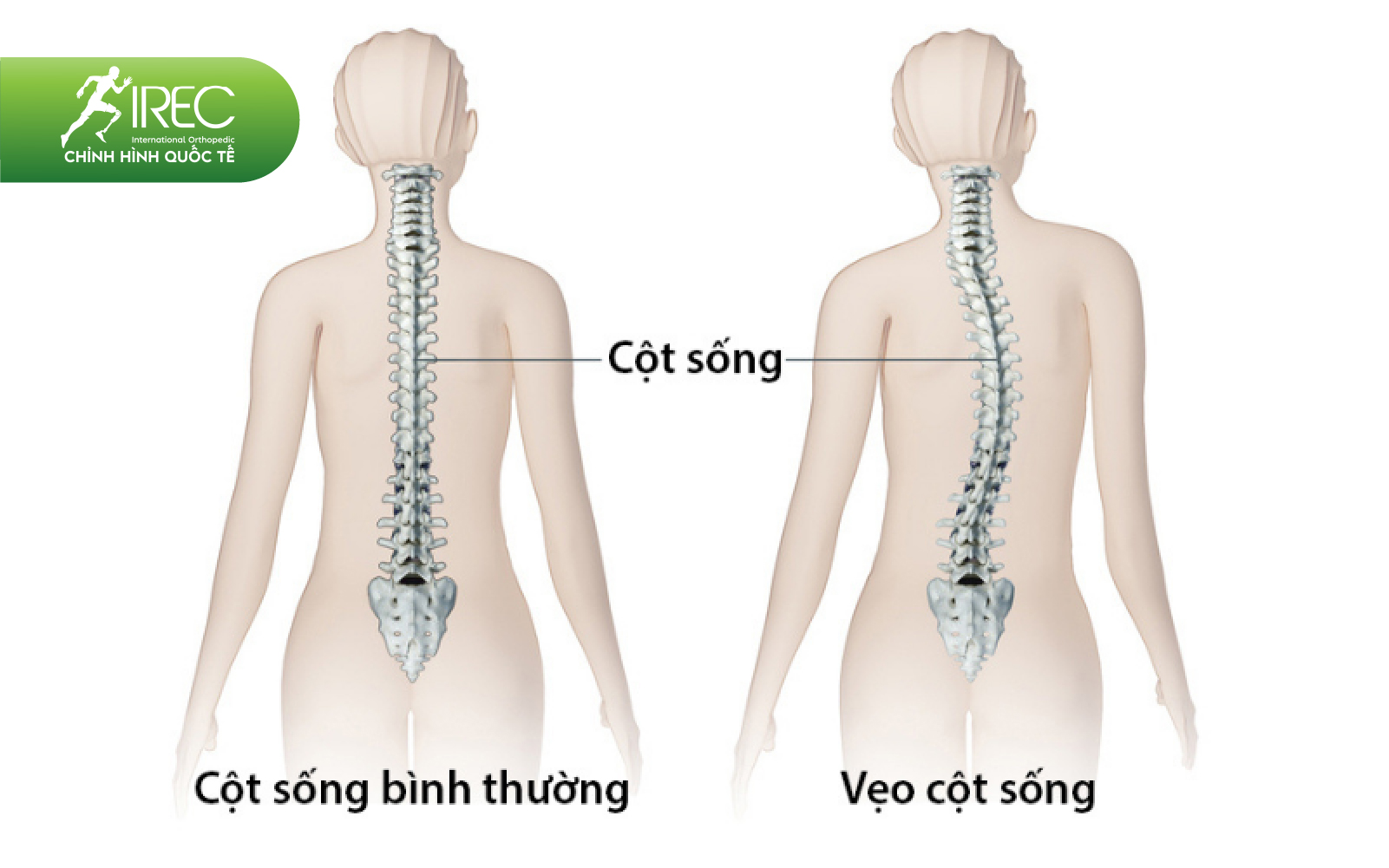 áo chỉnh hình 2D