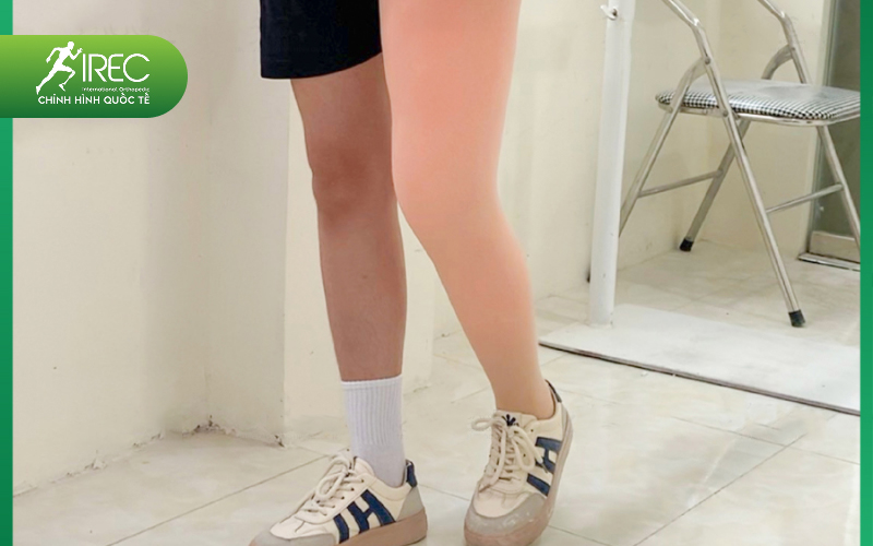 chân giả tháo khớp hông