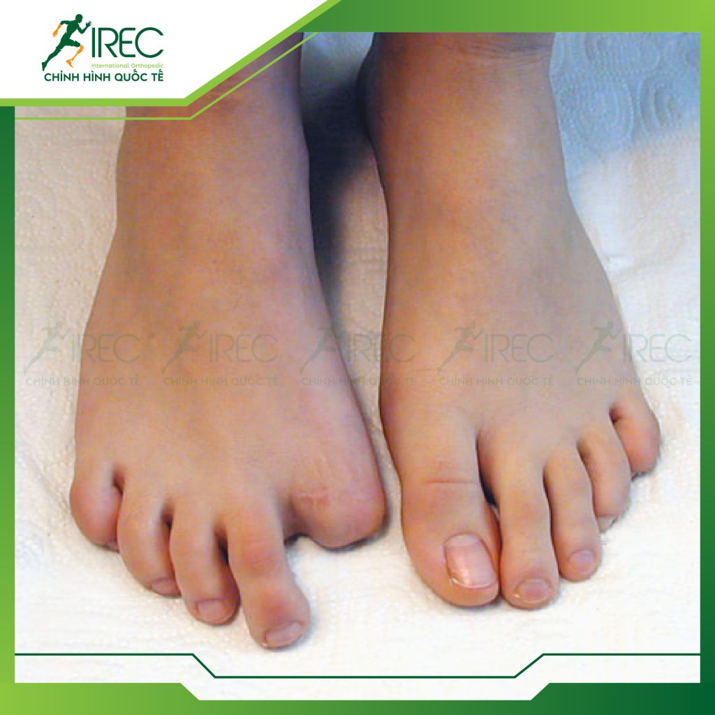 bài tập phục hồi mỏm cụt