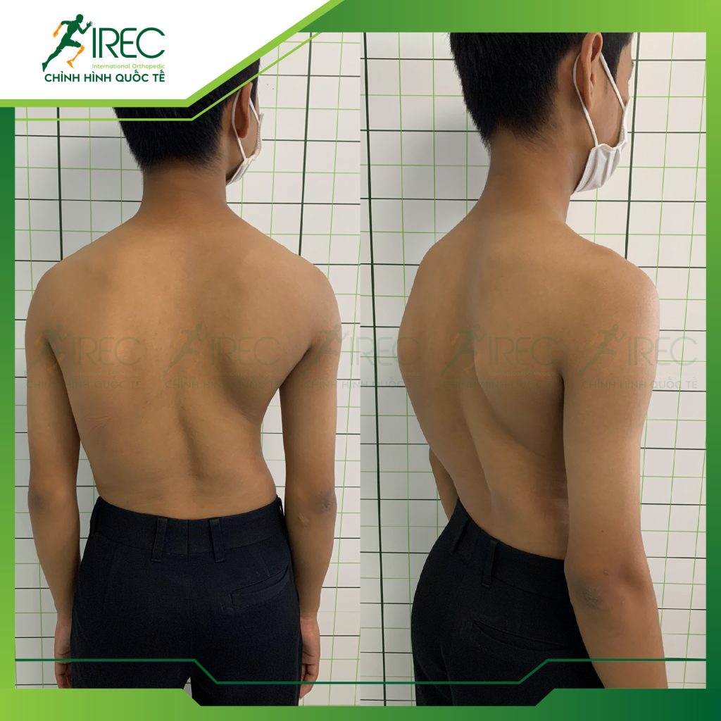 áo cong vẹo cột sống