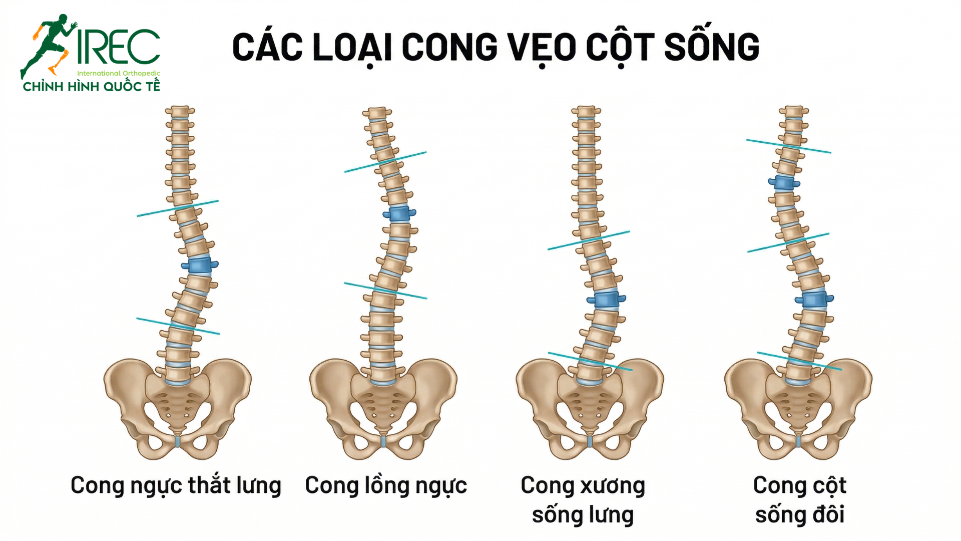 chống cong vẹo cột sống cần phải làm gì