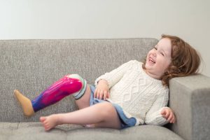 Phục Hồi Vận Động Cho Trẻ Mất Chân