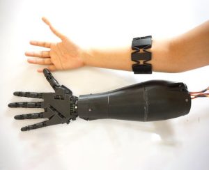 cách xử lý khi cánh tay giả bị lỏng.